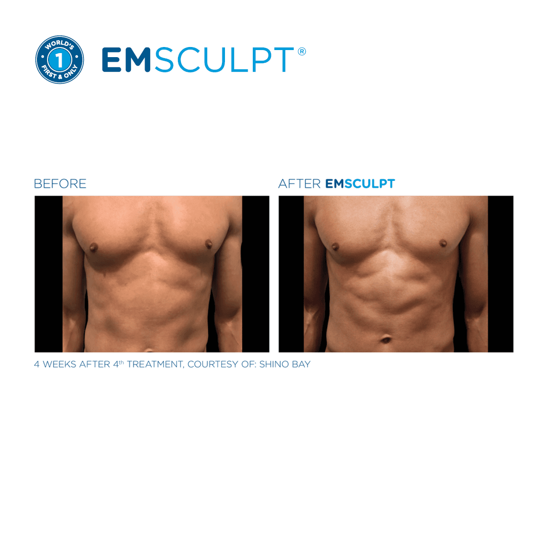 Abdominal Sculpting
